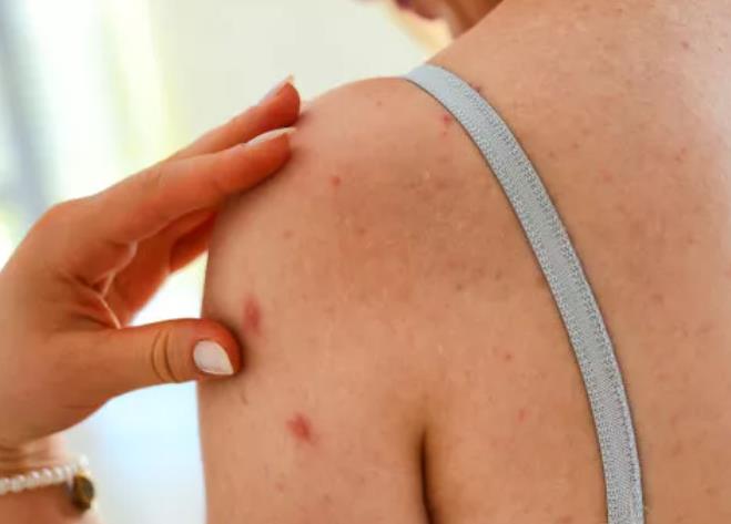 特应性皮炎是湿疹的一种吗？为什么会得特应性皮炎？